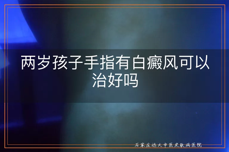两岁孩子手指有白癜风可以治好吗