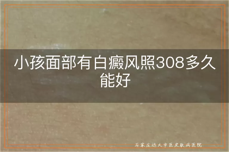 小孩面部有白癜风照308多久能好