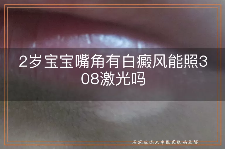 2岁宝宝嘴角有白癜风能照308激光吗