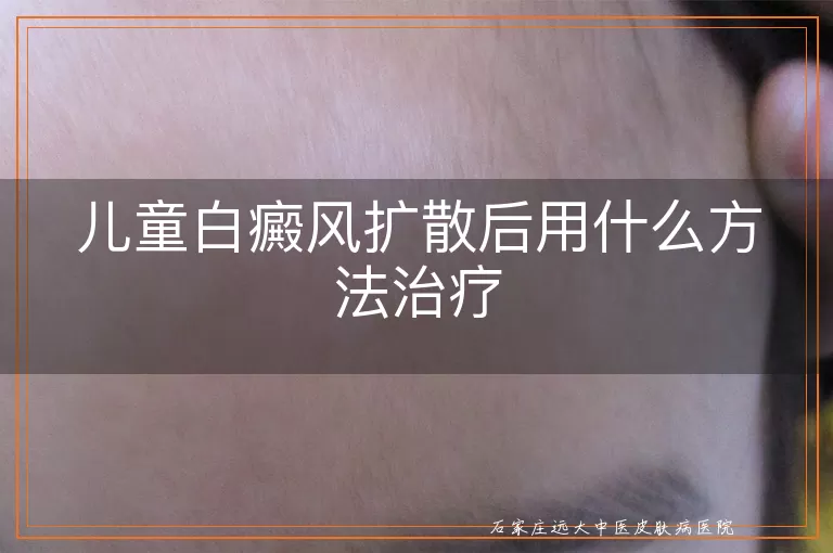 儿童白癜风扩散后用什么方法治疗