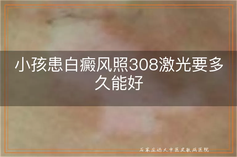小孩患白癜风照308激光要多久能好