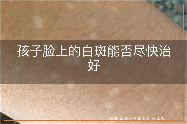 孩子脸上的白斑能否尽快治好
