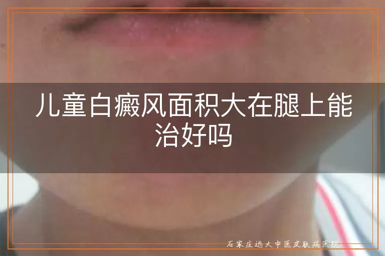 儿童白癜风面积大在腿上能治好吗