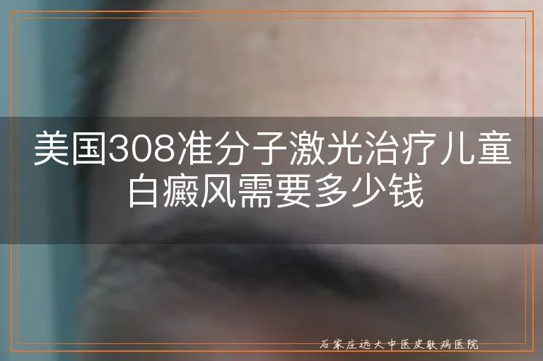 美国308准分子激光治疗儿童白癜风需要多少钱