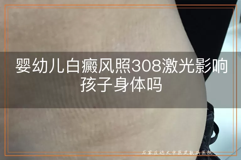 婴幼儿白癜风照308激光影响孩子身体吗