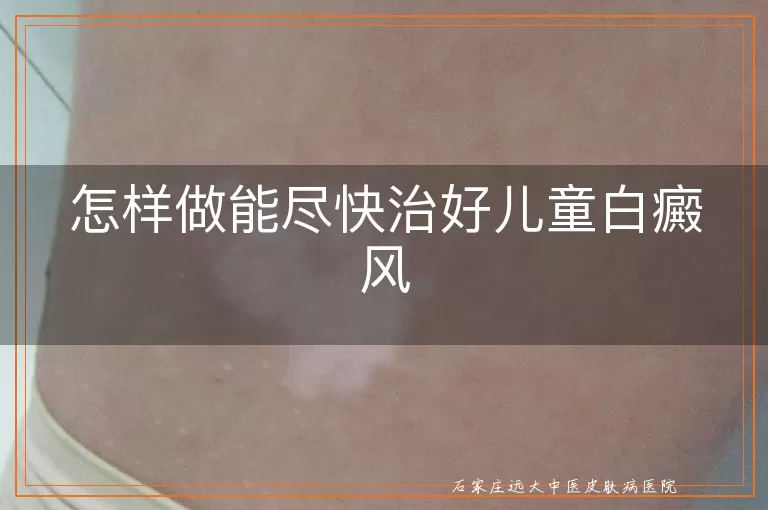 怎样做能尽快治好儿童白癜风