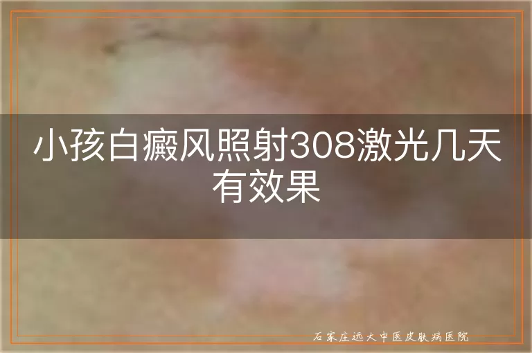 小孩白癜风照射308激光几天有效果
