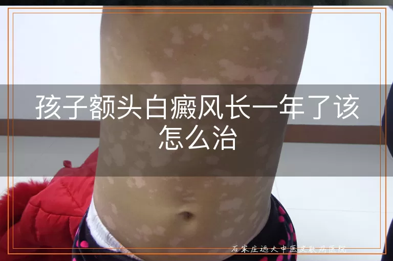孩子额头白癜风长一年了该怎么治
