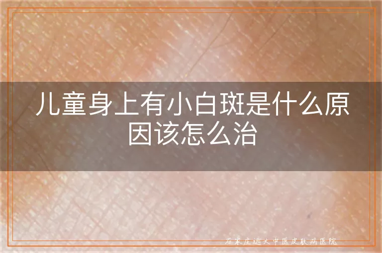 儿童身上有小白斑是什么原因该怎么治