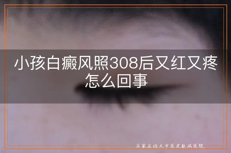 小孩白癜风照308后又红又疼怎么回事