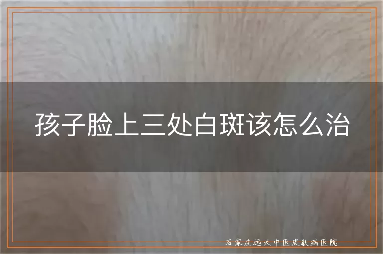 孩子脸上三处白斑该怎么治