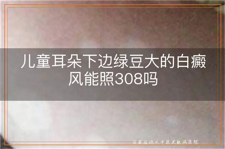 儿童耳朵下边绿豆大的白癜风能照308吗