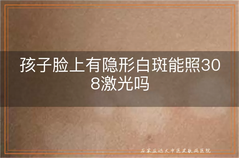 孩子脸上有隐形白斑能照308激光吗