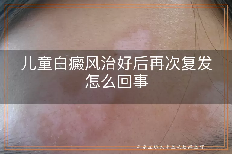 儿童白癜风治好后再次复发怎么回事