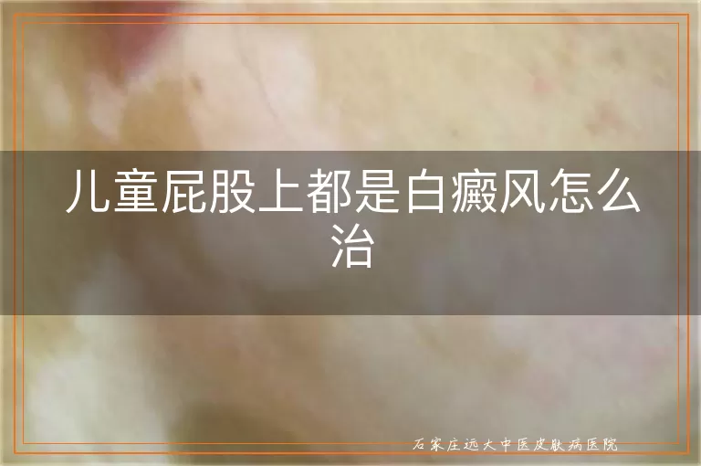 儿童屁股上都是白癜风怎么治