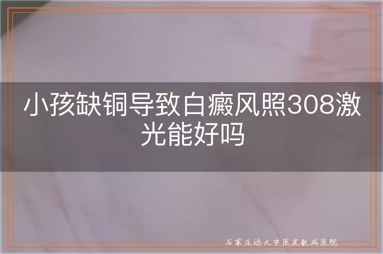 小孩缺铜导致白癜风照308激光能好吗