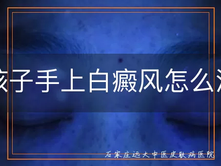 孩子手上白癜风怎么治