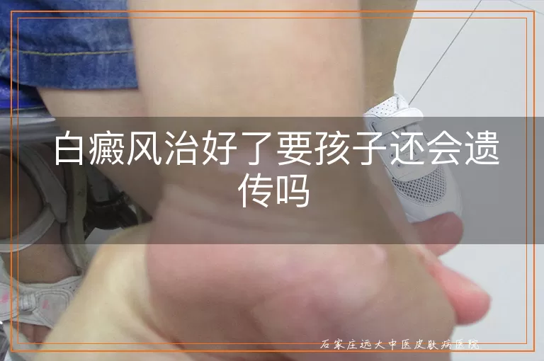 白癜风治好了要孩子还会遗传吗