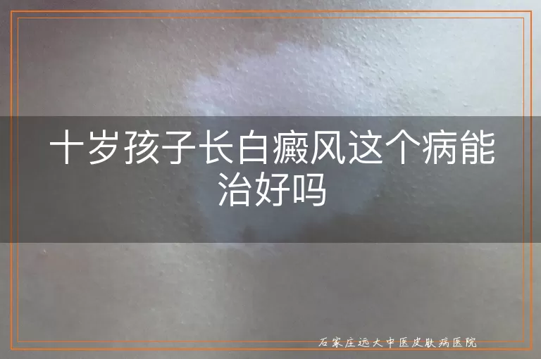 十岁孩子长白癜风这个病能治好吗