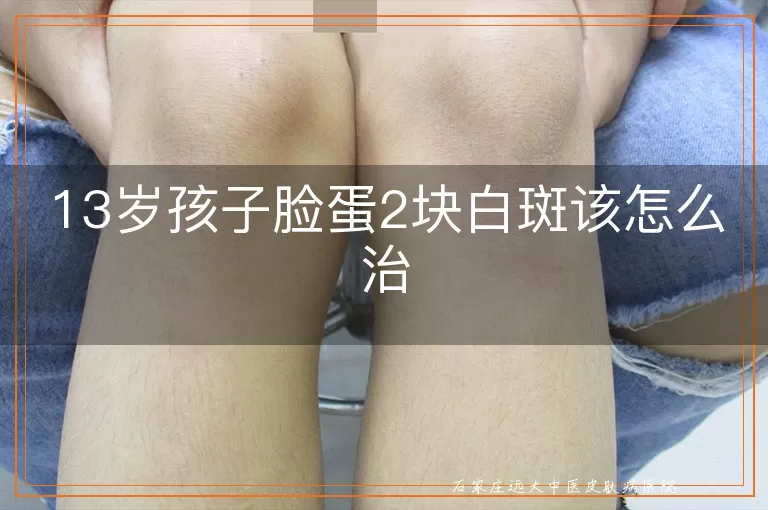 13岁孩子脸蛋2块白斑该怎么治