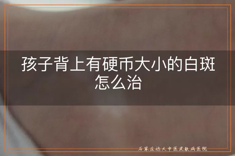 孩子背上有硬币大小的白斑怎么治