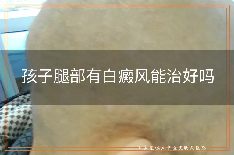 孩子腿部有白癜风能治好吗