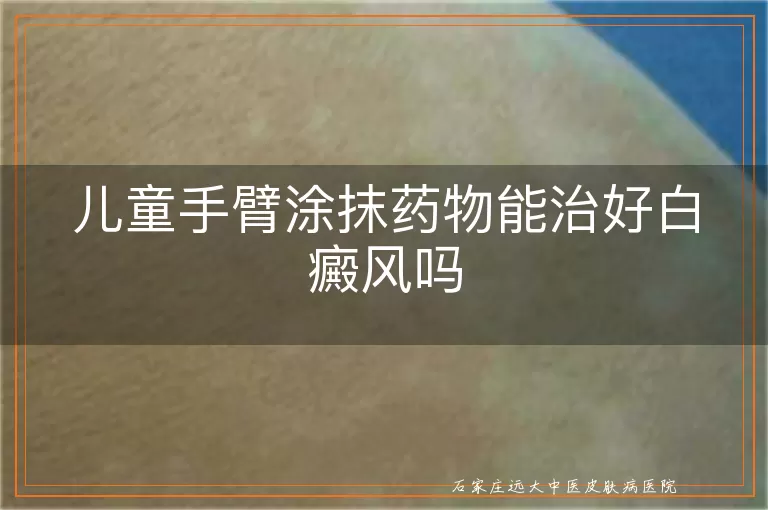 儿童手臂涂抹药物能治好白癜风吗