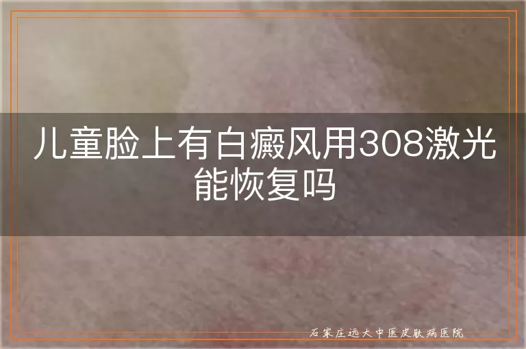 儿童脸上有白癜风用308激光能恢复吗