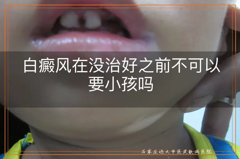 白癜风在没治好之前不可以要小孩吗