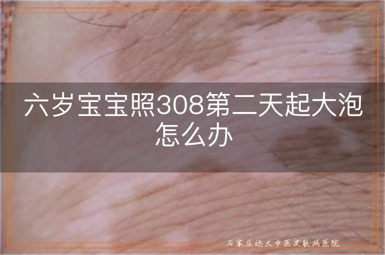 六岁宝宝照308第二天起大泡怎么办