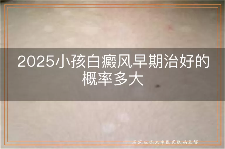 2025小孩白癜风早期治好的概率多大