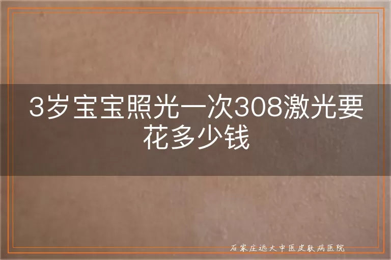 3岁宝宝照光一次308激光要花多少钱
