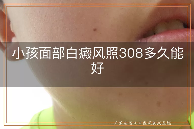 小孩面部白癜风照308多久能好