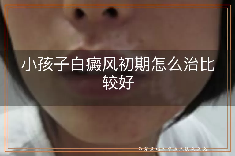 小孩子白癜风初期怎么治比较好