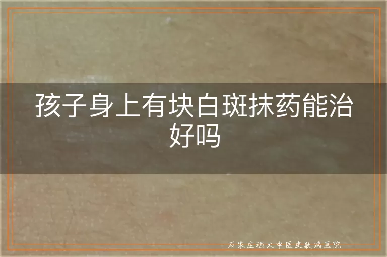 孩子身上有块白斑抹药能治好吗