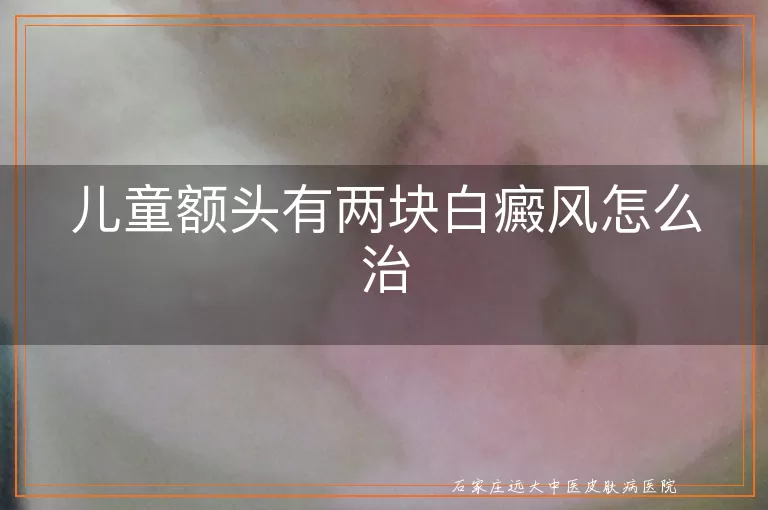 儿童额头有两块白癜风怎么治