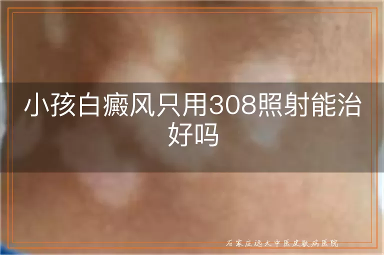 小孩白癜风只用308照射能治好吗