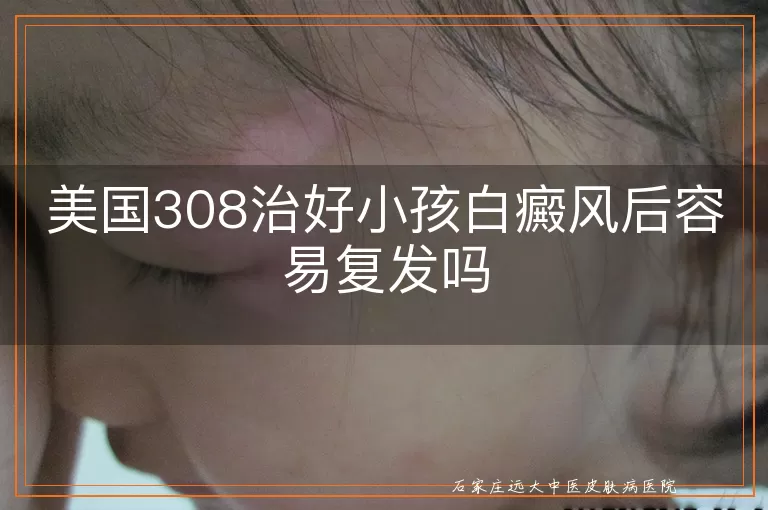 美国308治好小孩白癜风后容易复发吗