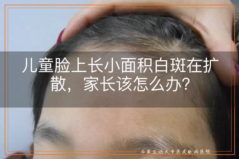 儿童脸上长小面积白斑在扩散，家长该怎么办？