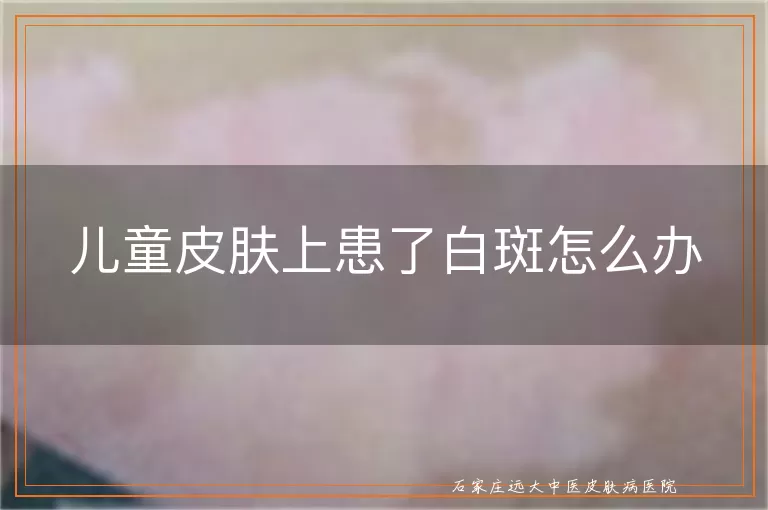 儿童皮肤上患了白斑怎么办