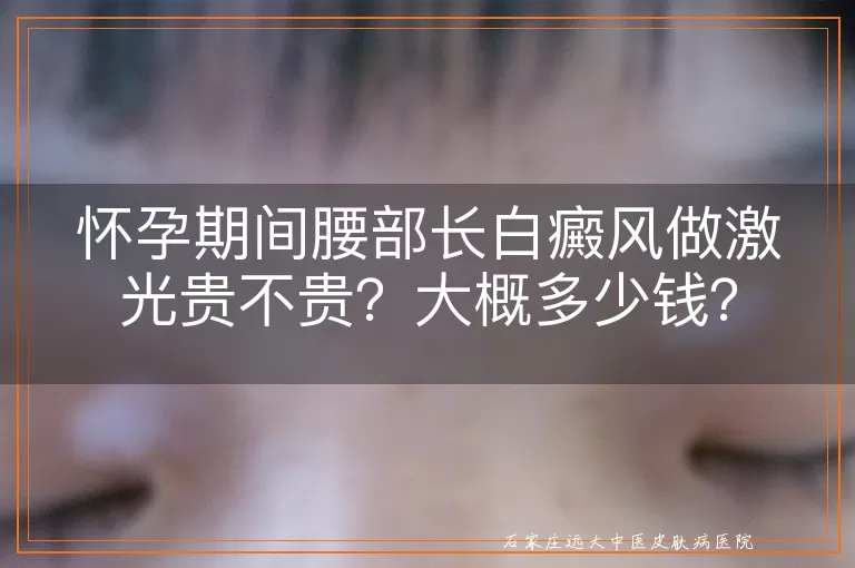 怀孕期间腰部长白癜风做激光贵不贵？大概多少钱？