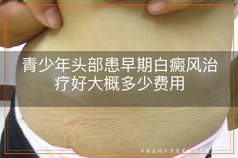 青少年头部患早期白癜风治疗好大概多少费用