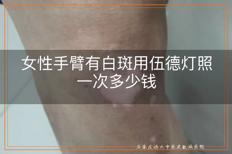 女性手臂有白斑用伍德灯照一次多少钱