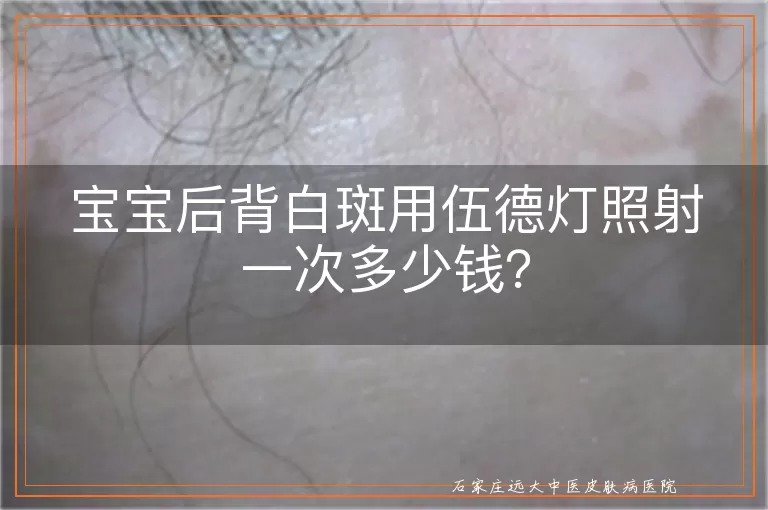 宝宝后背白斑用伍德灯照射一次多少钱？