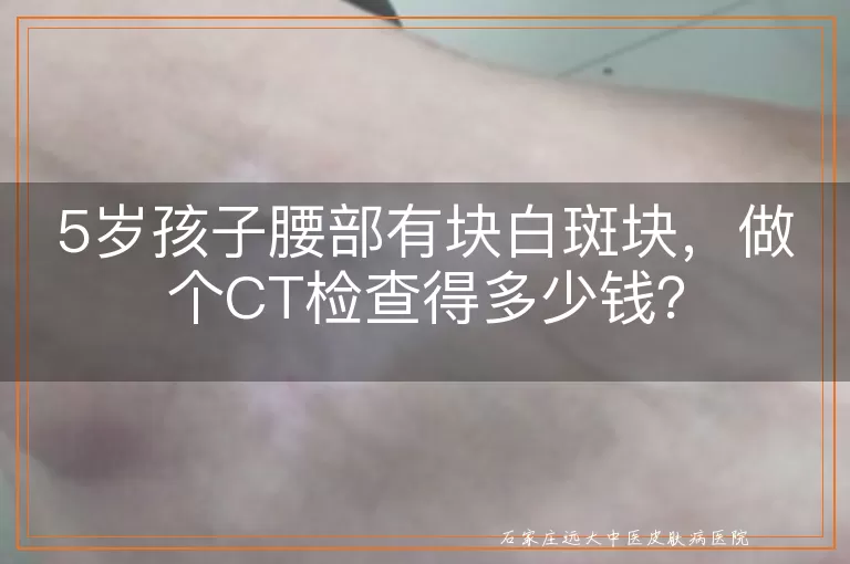 5岁孩子腰部有块白斑块，做个CT检查得多少钱？