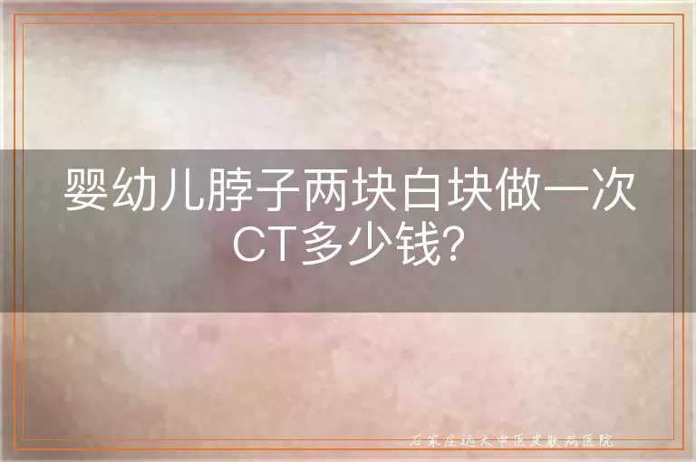 婴幼儿脖子两块白块做一次CT多少钱？