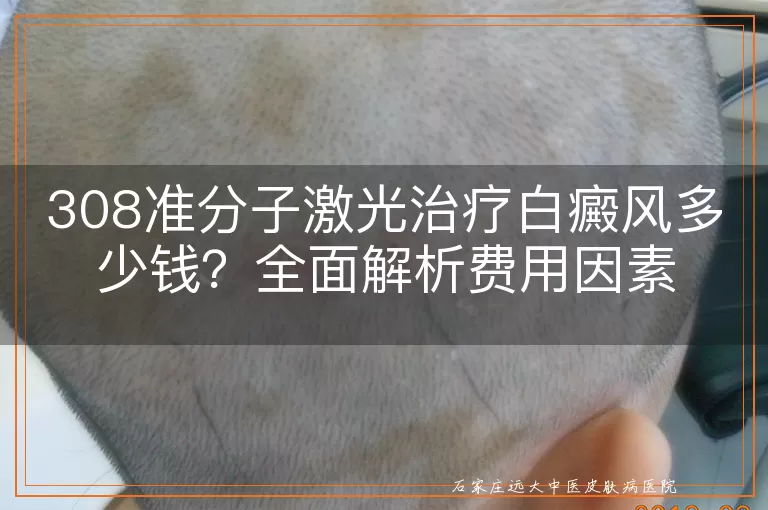 308准分子激光治疗白癜风多少钱？全面解析费用因素