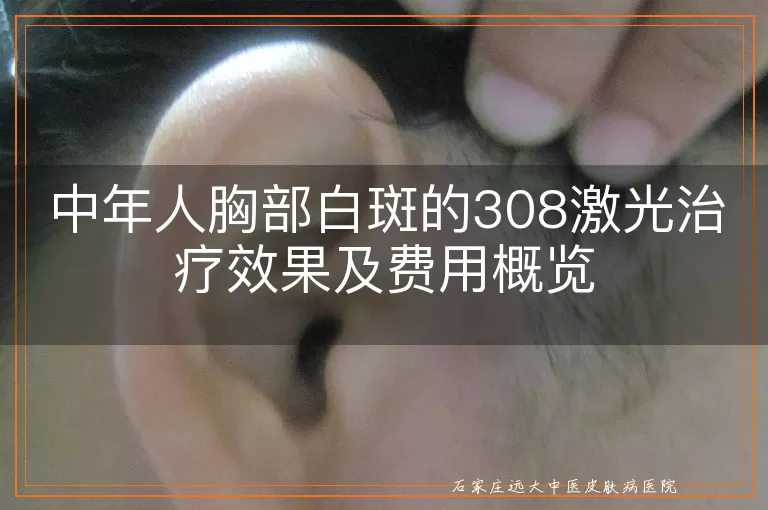 中年人胸部白斑的308激光治疗效果及费用概览