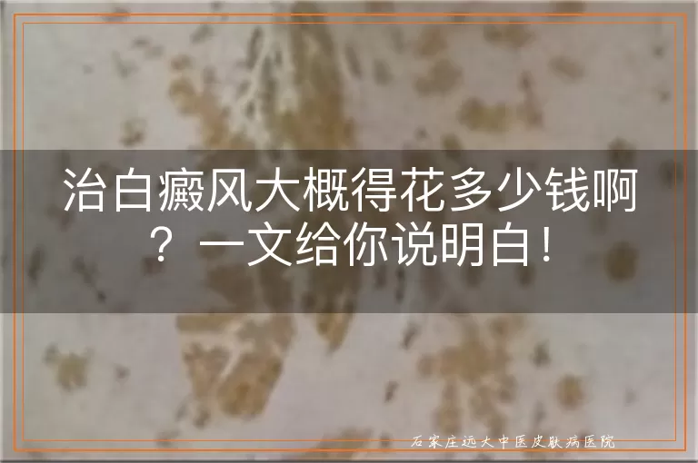 治白癜风大概得花多少钱啊？一文给你说明白！