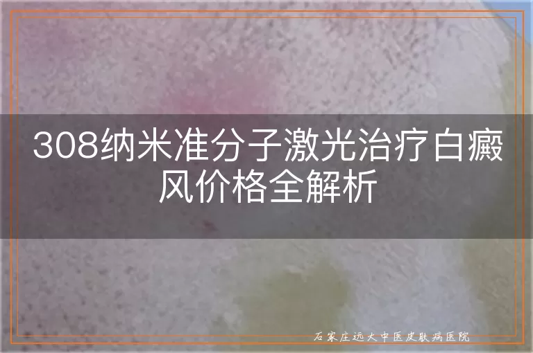 308纳米准分子激光治疗白癜风价格全解析